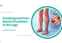 Smoking and Poor Blood Circulation in the Legs: How They Are Linked Illustration of leg arteries, a burning cigarette and a close-up of plaque narrowing an artery.