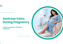 Varicose Veins During Pregnancy: Causes, Symptoms, Relief and Treatment Pregnant woman resting her feet on a footstool, with visible leg veins and a circular close-up of varicose veins.