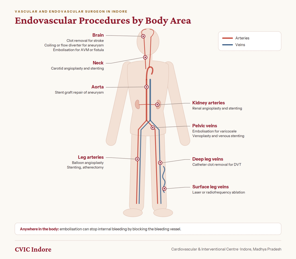 Common endovascular procedures by body area
