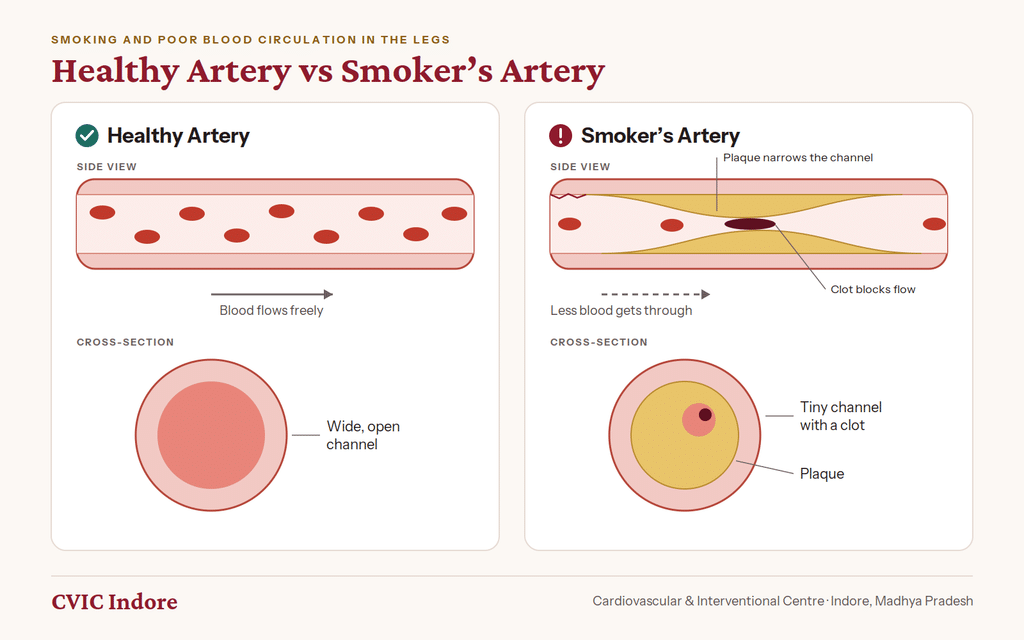 How smoking damages leg arteries