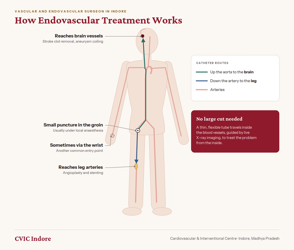 How endovascular treatment works